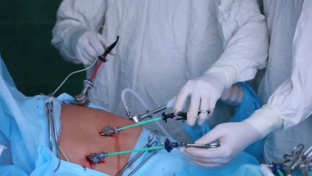 Laparoskopisk kirurgi i buken — Stockvideo