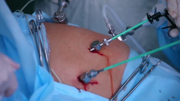 Laparoskopisk kirurgi i buken — Stockvideo