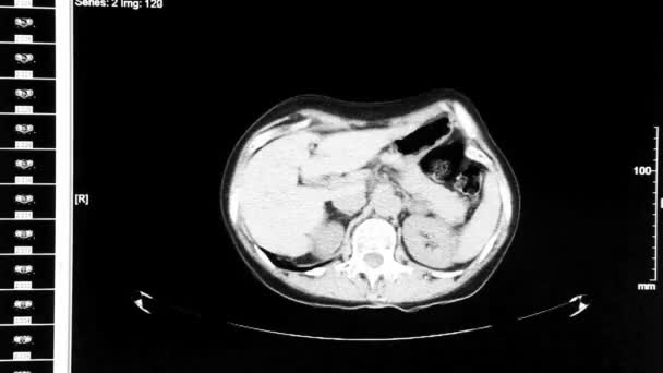 Počítačová tomografie vnitřních orgánů — Stock video