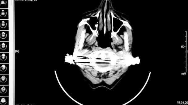Tomografia computadorizada de órgãos internos — Vídeo de Stock