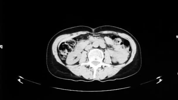 Tomografía computarizada de órganos internos — Vídeo de stock