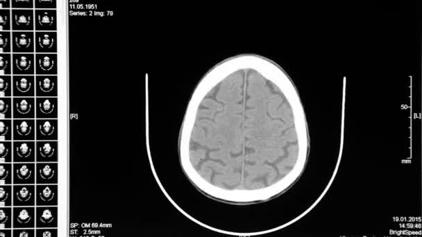 Tomografia multispettrale della testa — Video Stock