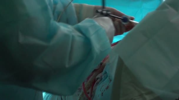 Chirurgie op darmen — Stockvideo