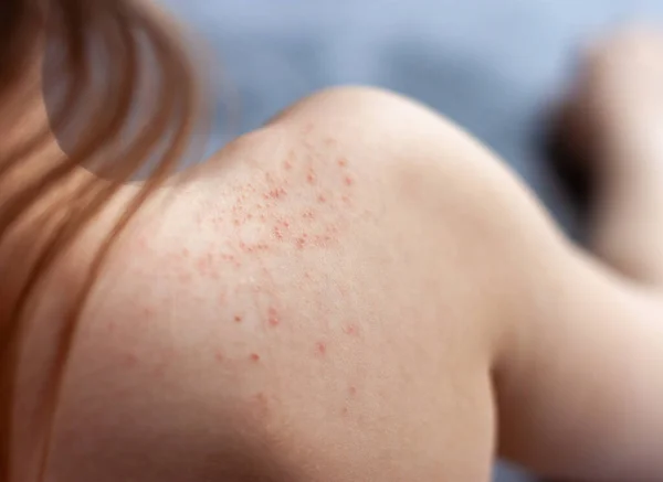 The shoulder of a child with red spots signs of dermatitis. — Stock Photo, Image