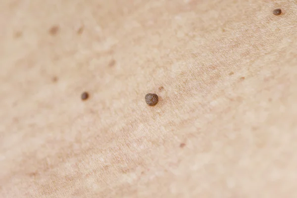 Warts - Skin Tag Disease — Stock Photo, Image