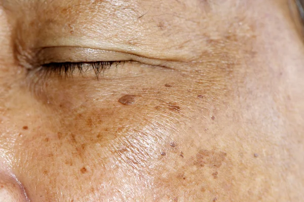 Melasma o sole bruciano pigmentazioni — Foto Stock