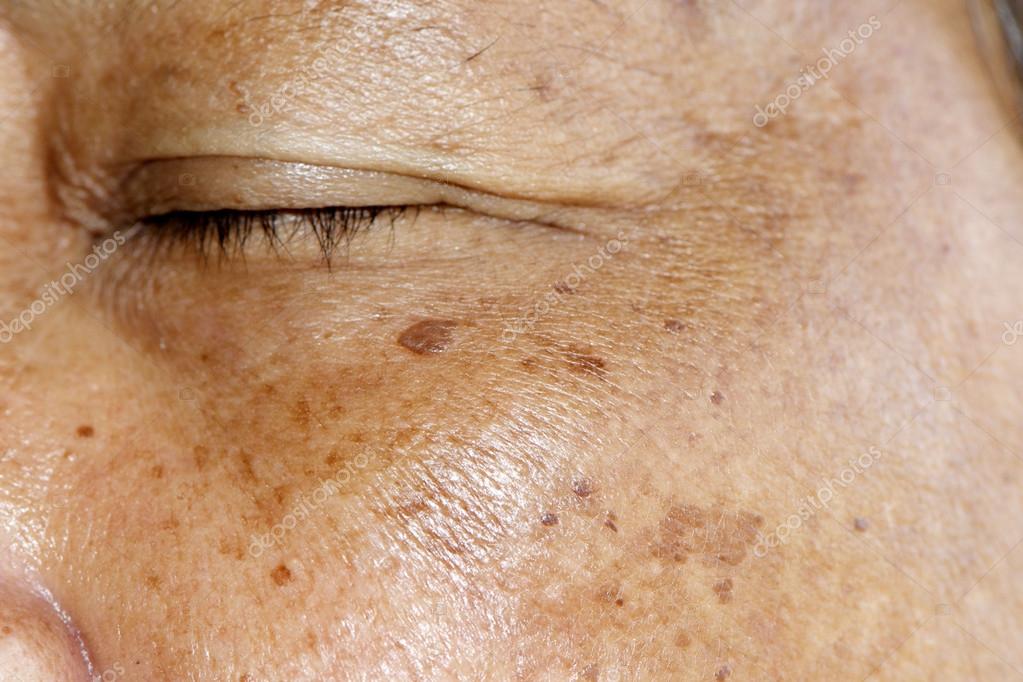 Age Spots Stock Photos Royalty Free Images Depositphotos Age Spots Stock Photos Royalty Free Images Depositphotos