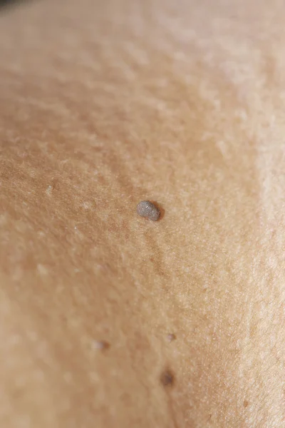 Verruche - Malattia del tag della pelle — Foto Stock