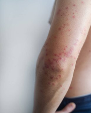 Kızamık enfeksiyonunun tipik bir örneği olan kızamık lekelerinin yavaş yavaş birleştiğini gösteren küçük kırmızı döküntüler erkeğin yüzüne ve vücuduna yayılır..