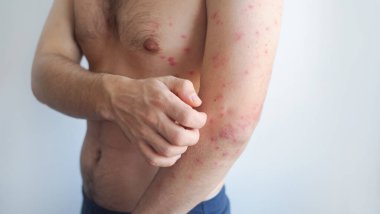 Pembe ince döküntüler, hafif viral semptomları minimum iltihaplanma ve tahriş ile gösteren bir erkeğin vücudunu kaplar..