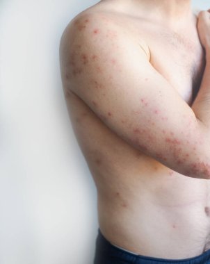 Vücudunda pembe kızarıklıklar olan bir adam hafif kaşıntı ve rahatsızlık yaşıyor. Videoda viral deri enfeksiyonu gösteriyor..