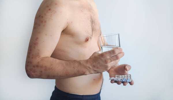 Man with red rash on body preparing to take medication for acne and allergies showing therapeutic skin treatment.