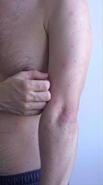 Tipik kızamık kızamığı olan bir adam, yüzü ve vücudu kaplayan kırmızı noktaları birleştiriyor ve ateşle birlikte vücudu da kaplıyor. Yüksek kalite 4k görüntü