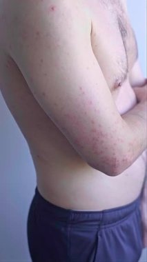 Göğsünde iltihaplı pullu deri ve kafa derisinde deri iltihabı olan bir adam. Yüksek kalite 4k görüntü