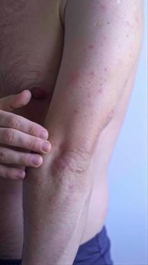 İnce pembe döküntüleri olan bir adam kendini kötü ve zayıf hisseden viral kızamık enfeksiyonunun tipik belirtileri. Yüksek kalite 4k görüntü