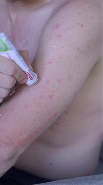 Geniş kızarıklık ve kızarıklık gösteren bir adam kaşıntıyı ve cilt bakımını azaltmak için yatıştırıcı krem sürüyor. Yüksek kalite 4k görüntü