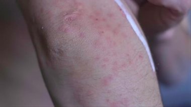 Videoda adamın kırmızı tahriş olmuş cilde krem sürdüğü ve kaşıntıyı ve rahatsızlığı azaltmaya yardım ettiği görülüyor. Yüksek kalite 4k görüntü
