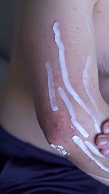 Cilt tahrişini azaltmak için yumuşatıcı krem sürerken erkek vücudunda birden fazla kırmızı nokta ve iltihap var. Yüksek kalite 4k görüntü