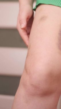 Bacaklardaki çürükler iyileşmek ve düzgün bir şekilde kaybolmak için zaman gerektiren tümseklerin genel belirtileridir. Yüksek kalite 4k görüntü