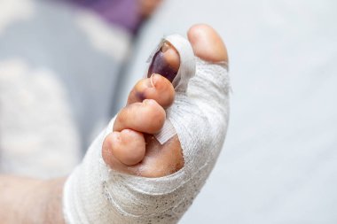 Hallux valgus için yapılan düzeltici ameliyattan sonraki 30 cm 'lik yakın çekim. Parmakları doğru pozisyonda tutmak için dar yüzler.