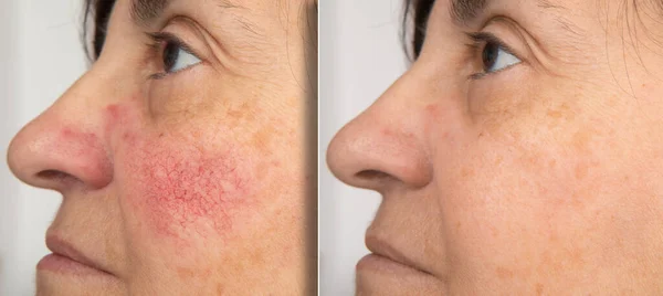 Olgun bir kadının yanaklarındaki kızarıklığı gösteren yakın plan portresi. Rosacea konsepti. Yüksek kalite fotoğraf