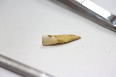 yırtılmış diş kaplaması görünümü