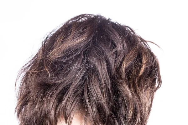 Hair Dandruff Close View — Stock Photo, Image