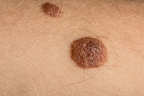 close- up view of human skin with moles