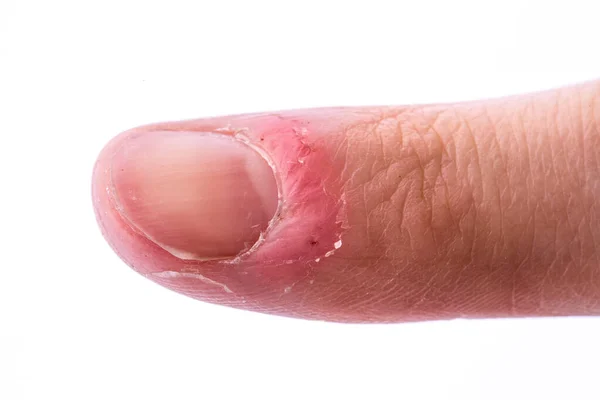 Close Van Gewonde Vrouwelijke Vinger Witte Achtergrond — Stockfoto