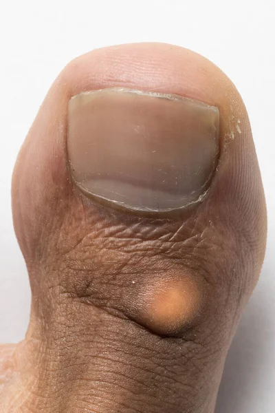 Closeup view of big toe with bump