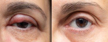 Stye tedavisinden önce ve sonra kadın gözü. Göz kapağında şişlik var. Sonra sönük ve sağlıklı görünüyor.