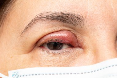 Chalazion 'lu bir gözün kapatılması, konjonktivit ve bakteriyel enfeksiyondan dolayı kırmızı gözkapağı ile şişmiş gözüne üzülen olgun bir kadının yüzünün ayrıntıları.
