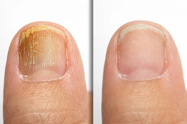 Onychomycosis 'ten muzdarip olan bir kişinin ayak başparmağında mantar tedavisi öncesi ve sonrası görülmektedir, mantar enfeksiyonu ayak tırnağının sararmasına neden olur.