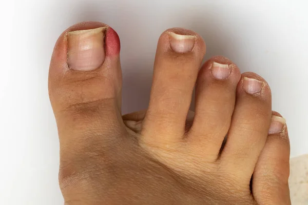 Macro of a lady\'s big toe with ingrown toenail. Red and swollen skin due to skin inflammation and underlying push. Need for medical surgery