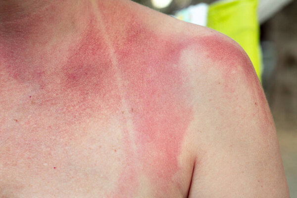 Покраснение и знак купальника на коже молодой женщины, вызванные воздействием солнца. Сожжение, вызванное солнечными лучами от самых жарких часов летнего дня. Концепция ухода за кожей.