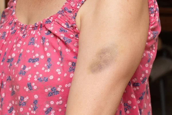 Contusão Braço Uma Mulher Sintoma Hematoma Capilares Frágeis Patologias Trombóticas — Fotografia de Stock