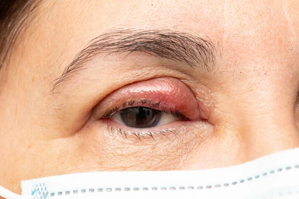 stock image Closeup of an eye with chalazion, details of the face of a mature woman sad about her swollen eye with red eyelid due to conjunctivitis and bacterial infection