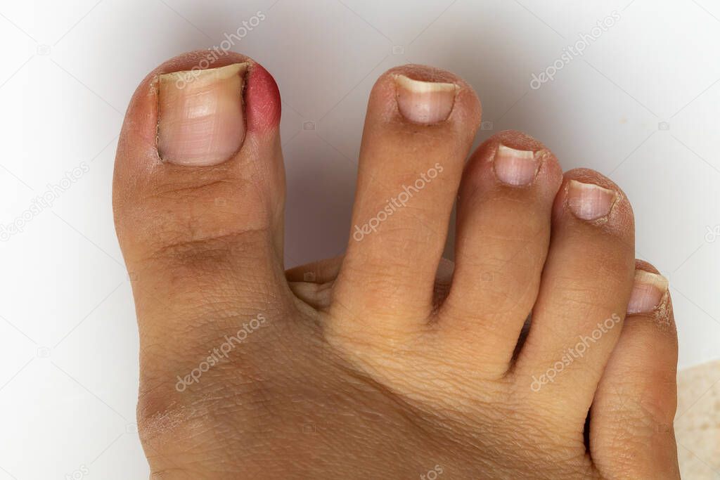 Macro of a lady's big toe with ingrown toenail. Red and swollen skin due to skin inflammation and underlying push. Need for medical surgery