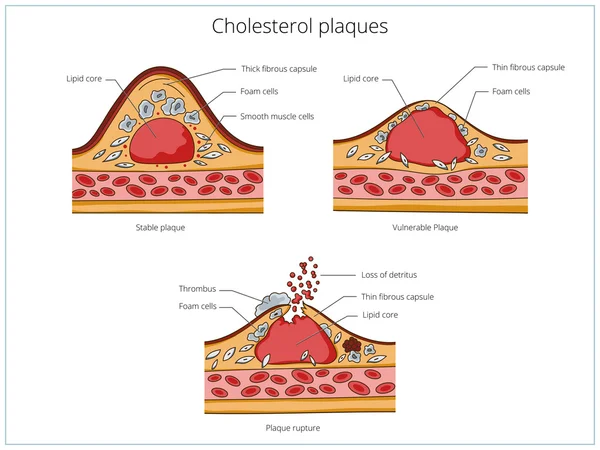 Cholesterolu plaketu zdravotnické vzdělávací vektor — Stockový vektor