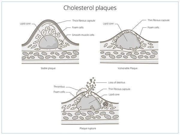 Cholesterolu plaketu zdravotnické vzdělávací vektor — Stockový vektor