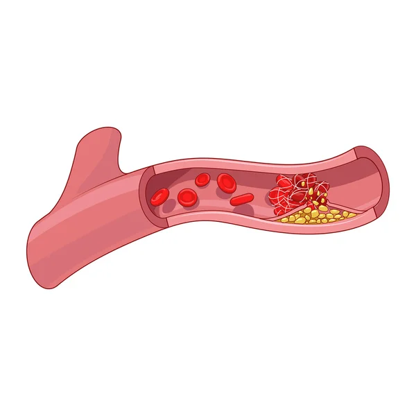 Ilustración de vasos sanguíneos y trombos de coágulo — Vector de stock