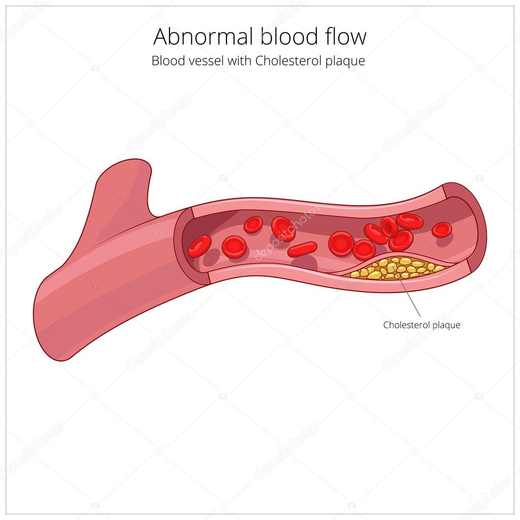 Blood vessel and cholesterol plaque vector