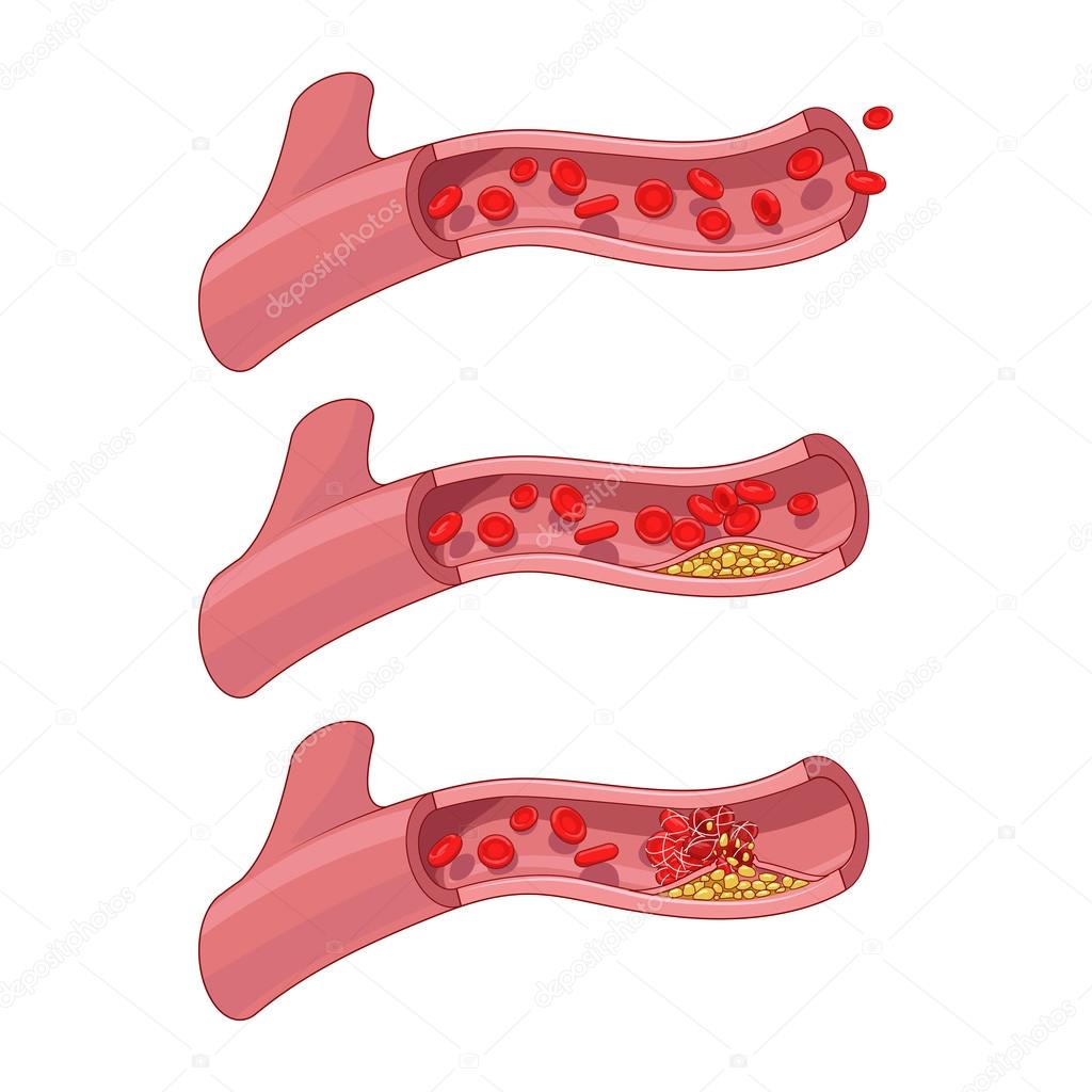 Blood vessel and clot thrombus vector illustration