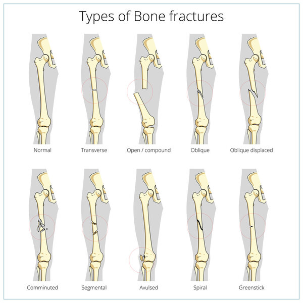 Виды переломов костей медицинский образовательный вектор
