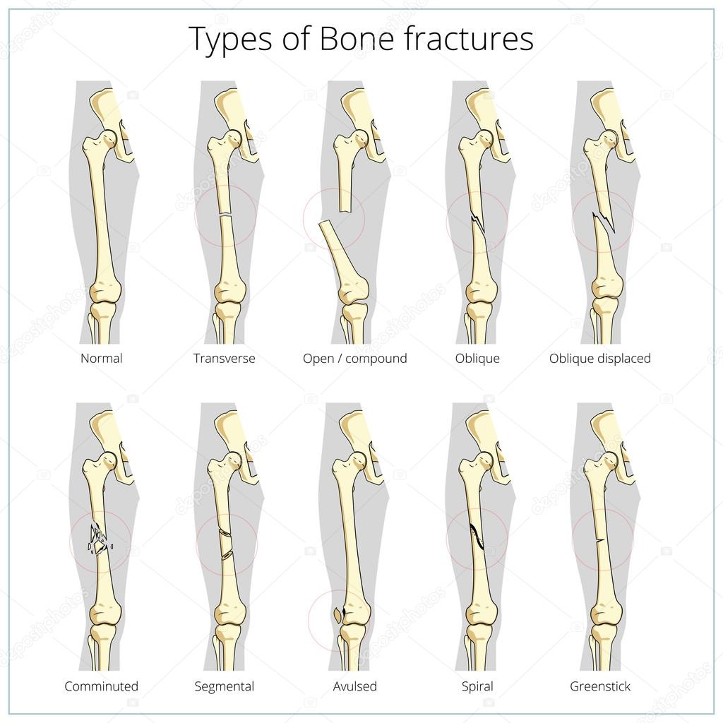 Types of bone fractures medical educational vector