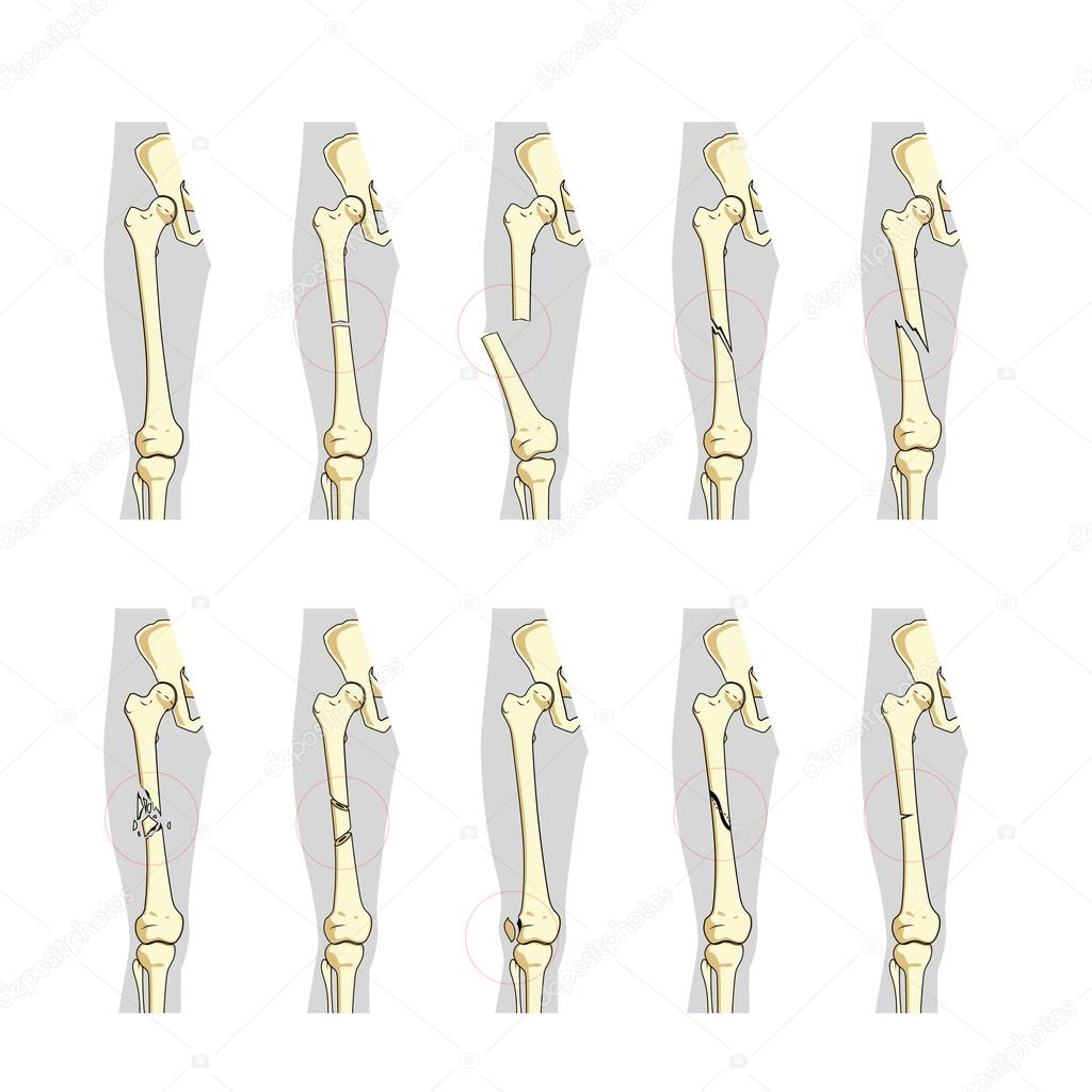Types of bone fractures medical educational vector