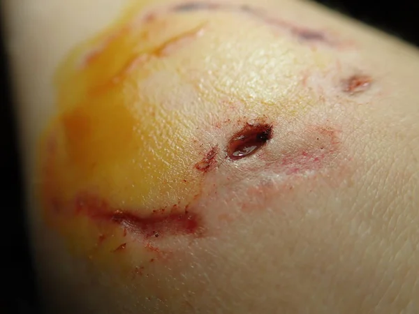 Detail Dog Bite Wound Hand Iodine Desinfection — Stock Photo, Image