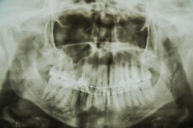 Tıbbi x-ray diş ve kafatası siyah kapat 