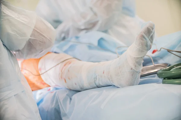 Primer plano de un pie con el vendaje del paciente a la cirugía en el cuello del fémur en el quirófano en un hospital — Foto de Stock