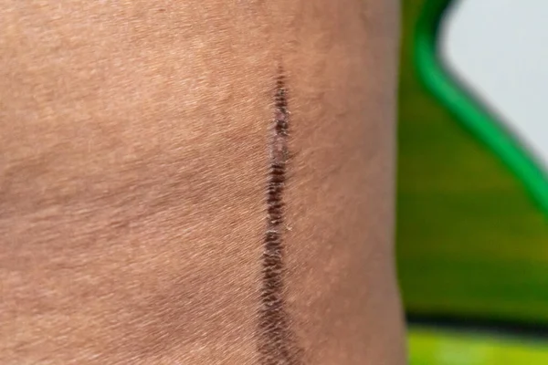 close up stretch Marks and dead skin of fat man